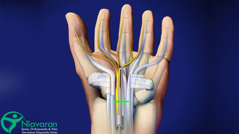 اقدامات قبل از عمل عصب دست