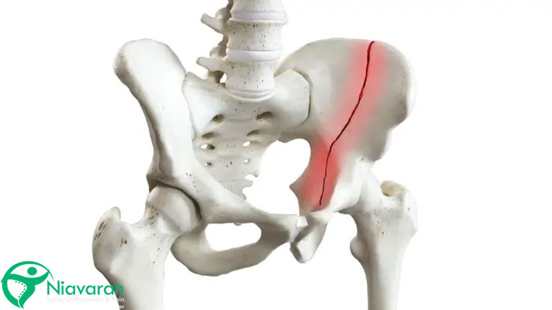 شکستگی استخوان لگن