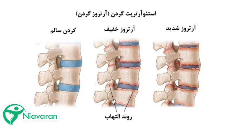 علائم آرتروز گردن در مهره ها