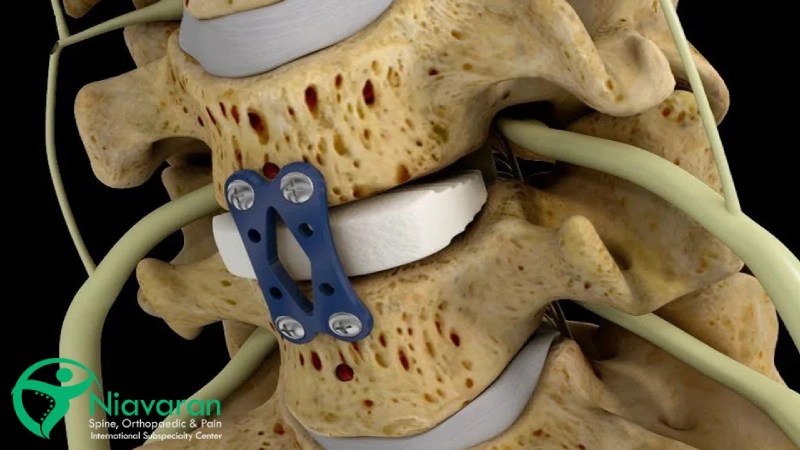 درمان فتق دیسک گردن با جراحی