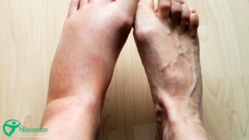 علائم آب آوردن پا