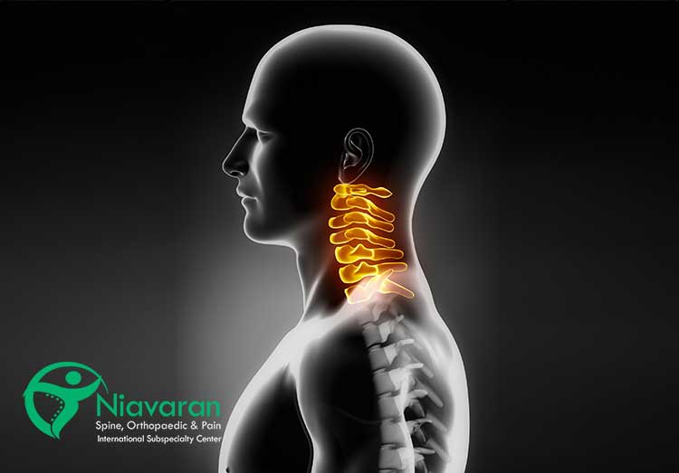 بیرون زدگی دیسک گردن