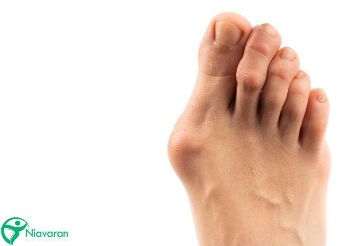 بیماری هالوکس والگوس