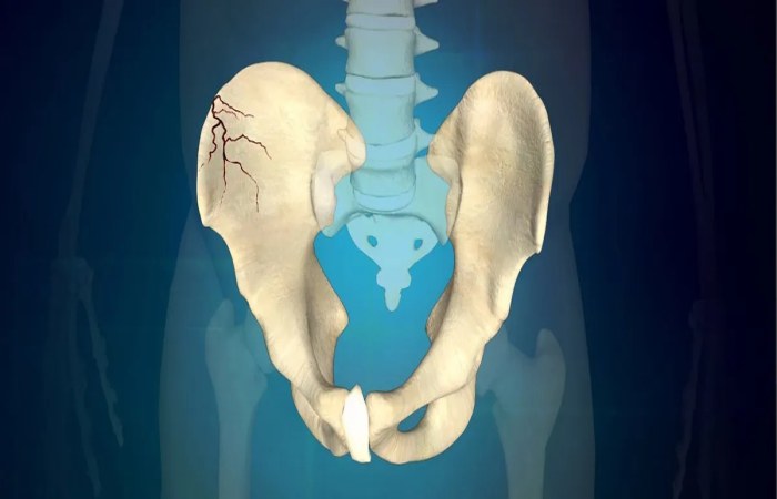 شکستگی لگن در سالمندان