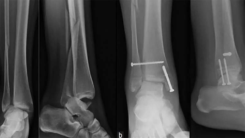 شکستگی مچ پا