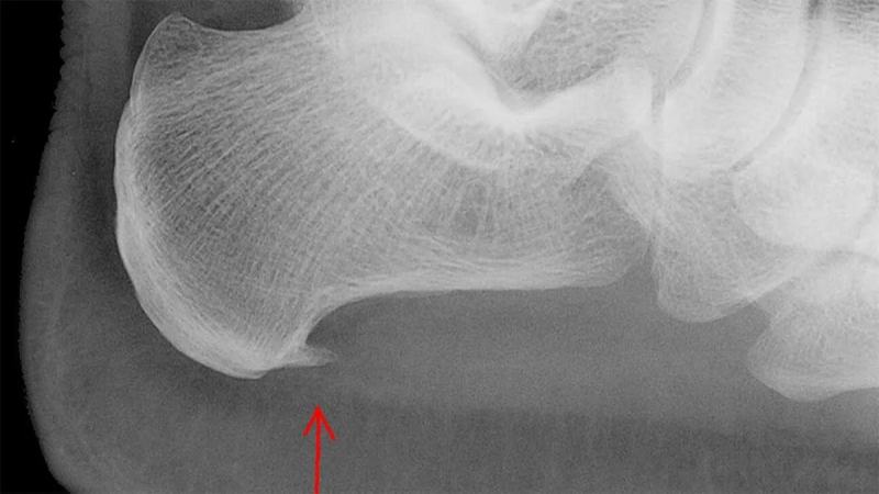خار استخوانی یا استئوفیت چیست