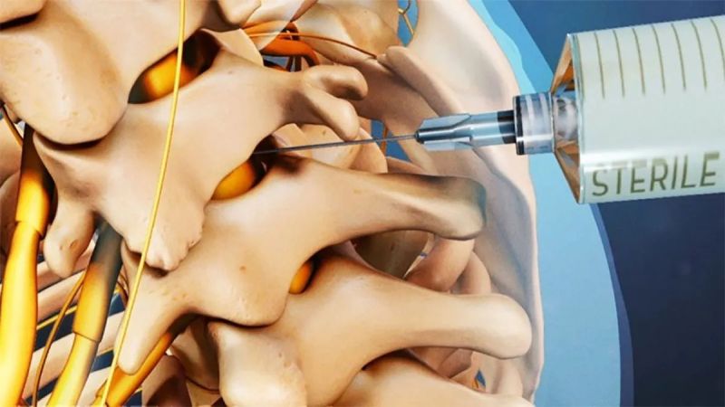 تزریق اپیدورال چیست