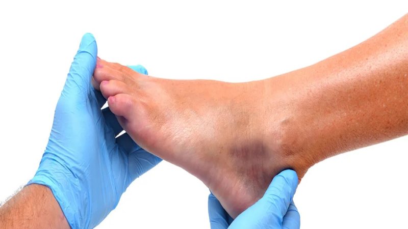 پیچ خوردگی مچ پا