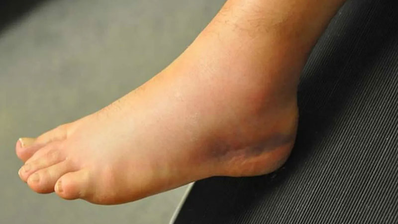 رایج ترین بیماری های مچ پا